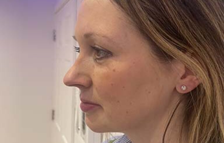 Facial Aesthetics – Before
