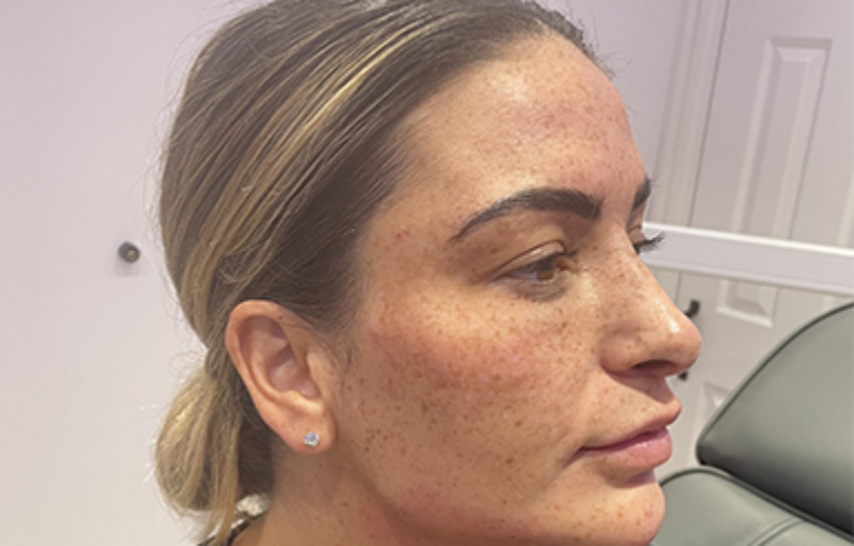 Facial Aesthetics – After
