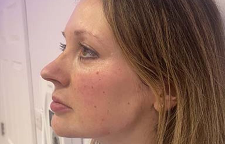 Facial Aesthetics – After