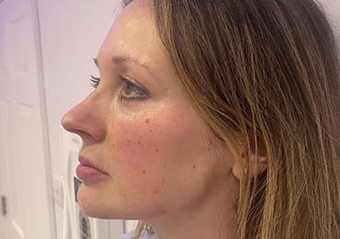 https://www.priyeshladaesthetics.co.uk/wp-content/uploads/2023/04/case8aft.jpg